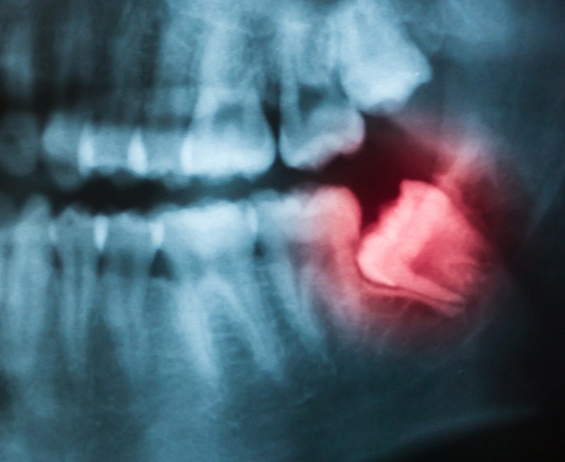 Dental X-ray showing a set of teeth with an impacted wisdom tooth highlighted in red in the lower jaw, tilted sideways and pressing against a neighboring tooth.